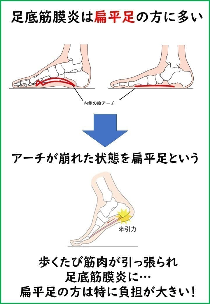扁平足