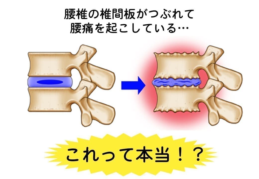 椎間板による腰痛