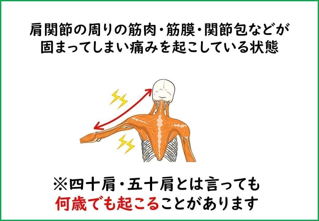 四十肩・五十肩とは