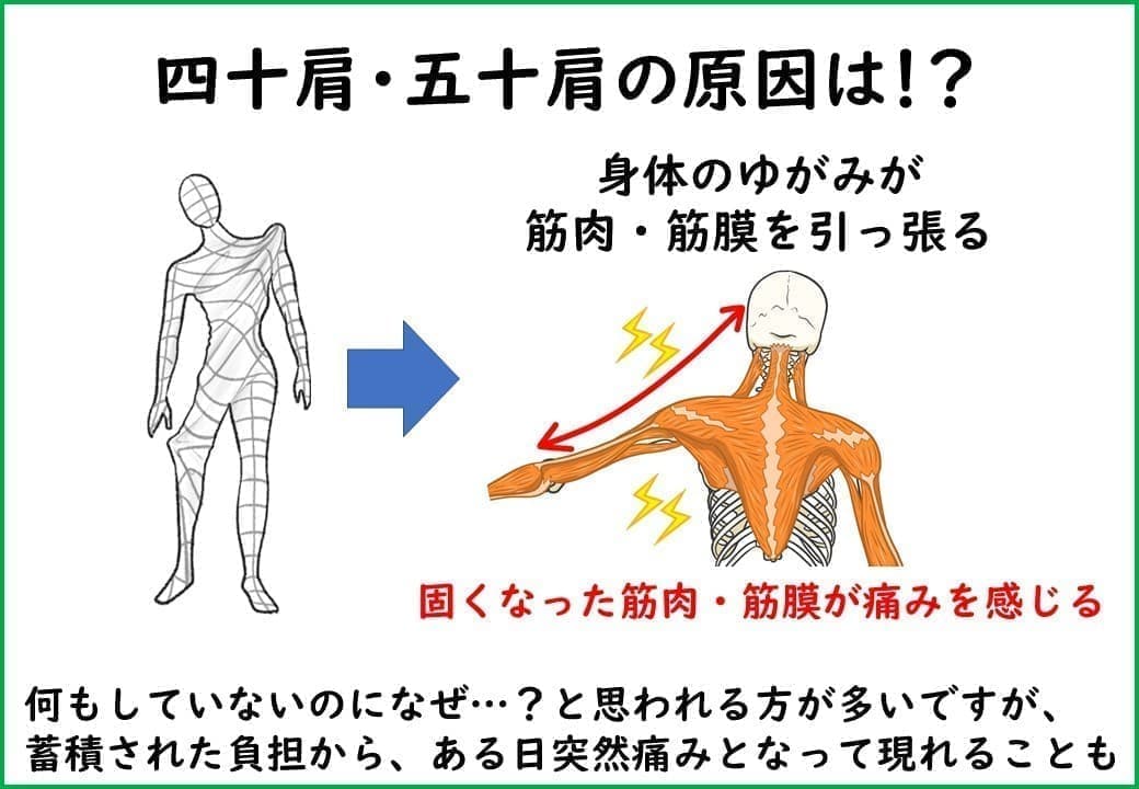 四十肩・五十肩の原因