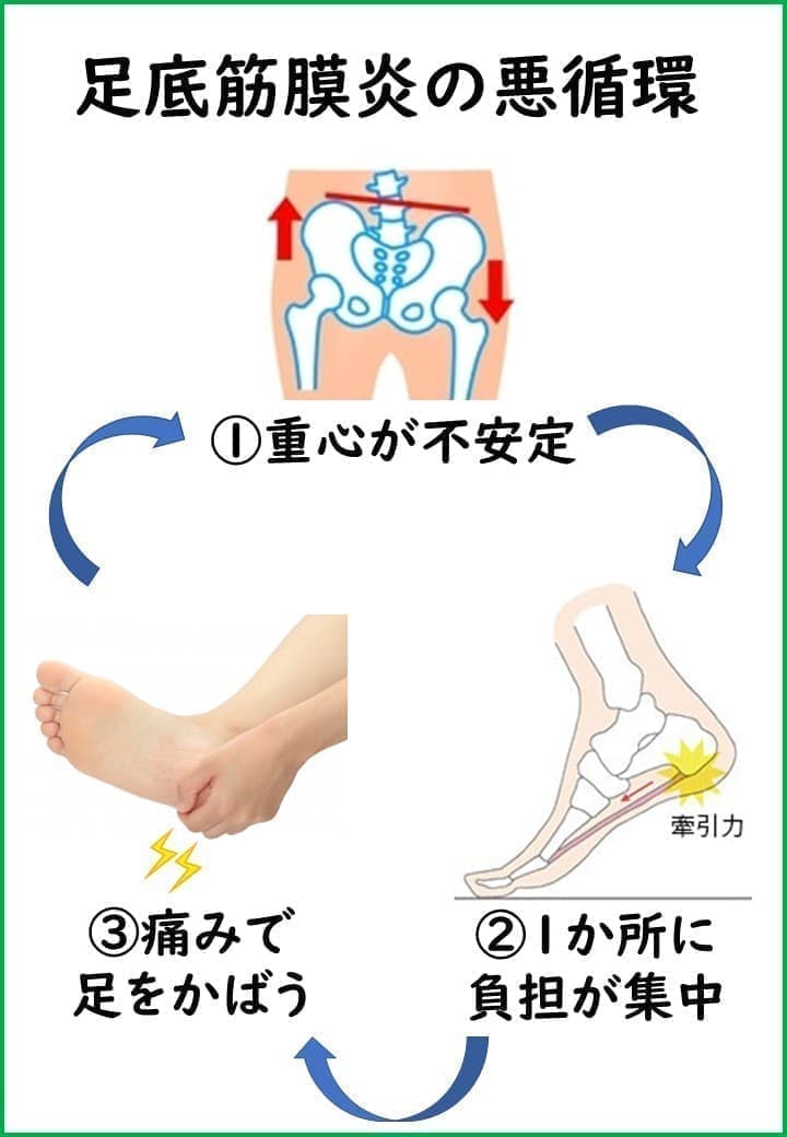 足底筋膜炎の悪循環