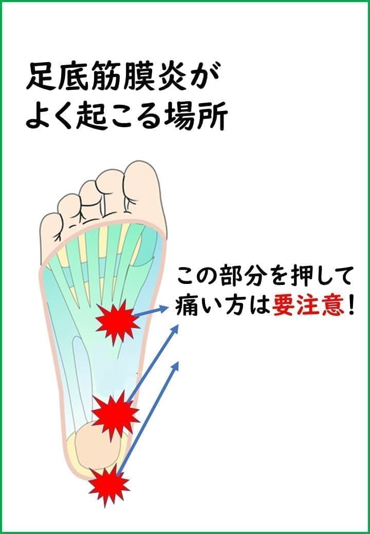 足底筋膜炎が起こる場所