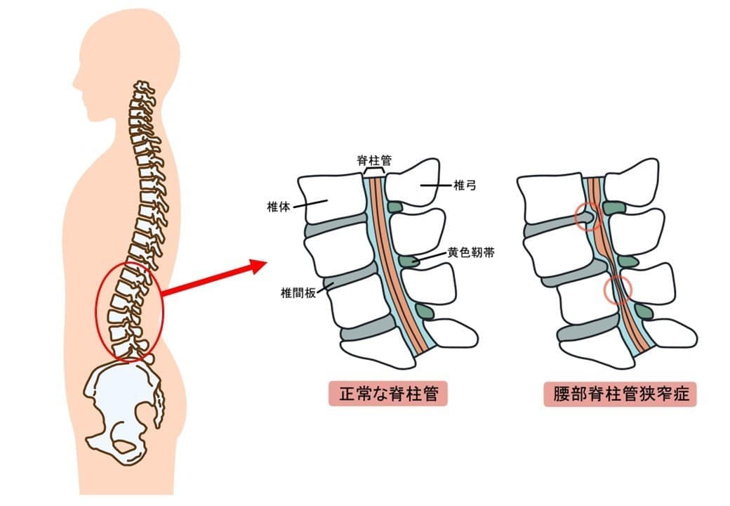 脊柱管狭窄症