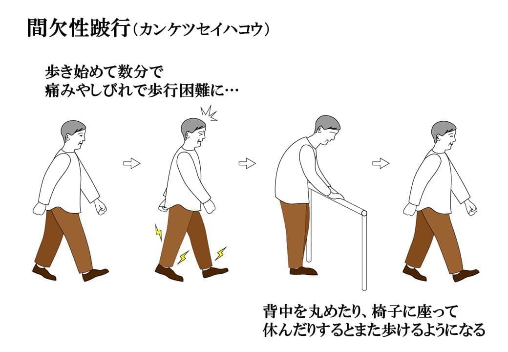 間欠性跛行