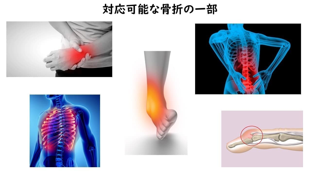 対応可能な骨折