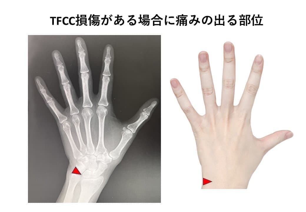 TFCC損傷